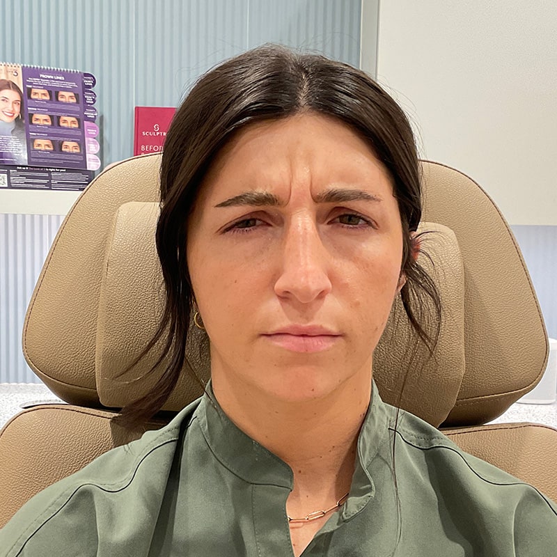 Botox & Dysport Before & After Image