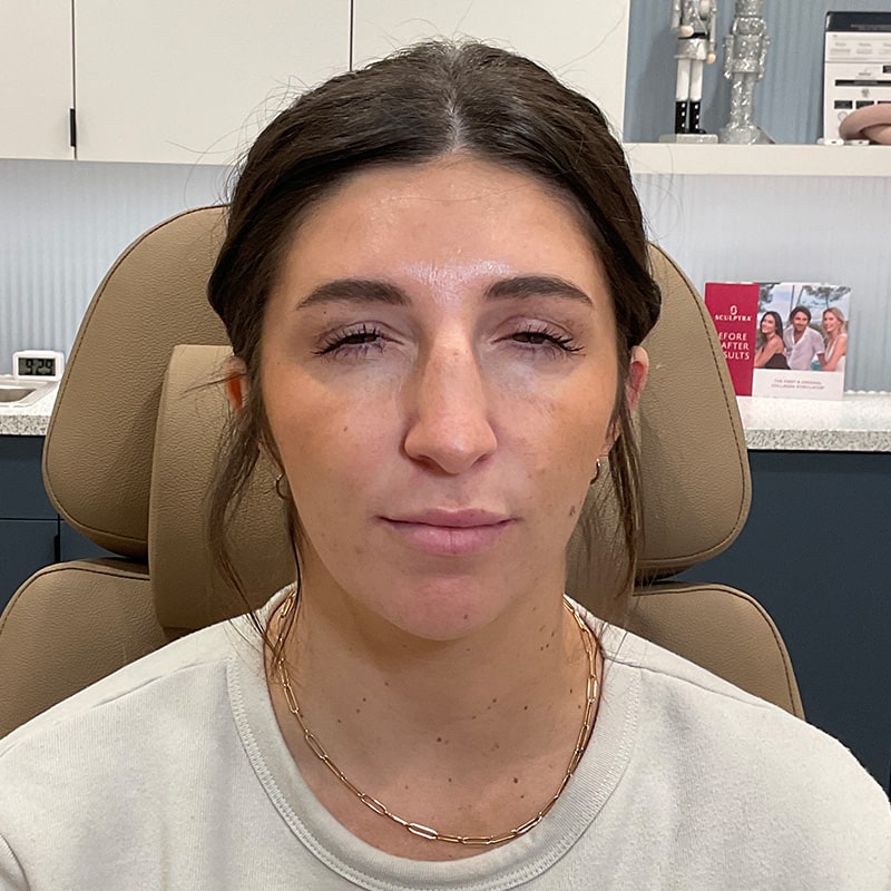 Botox & Dysport Before & After Image