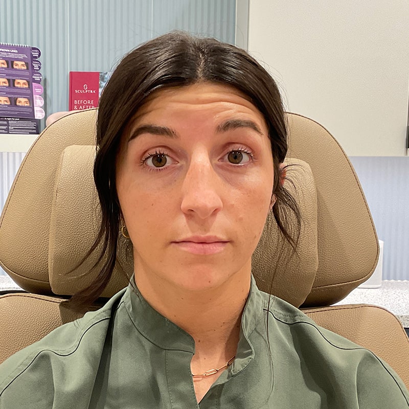 Botox & Dysport Before & After Image