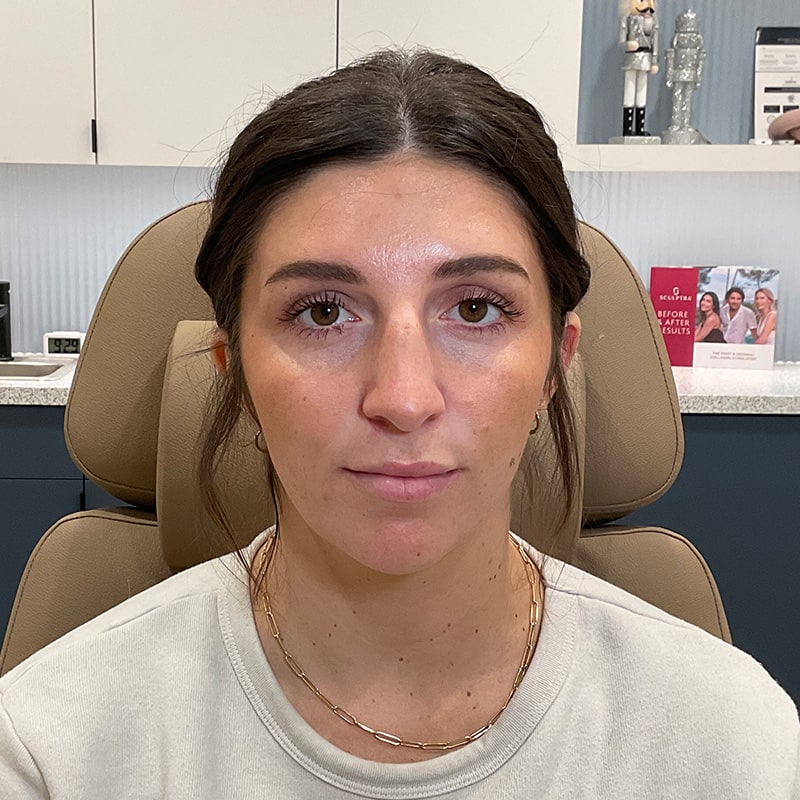 Botox & Dysport Before & After Image