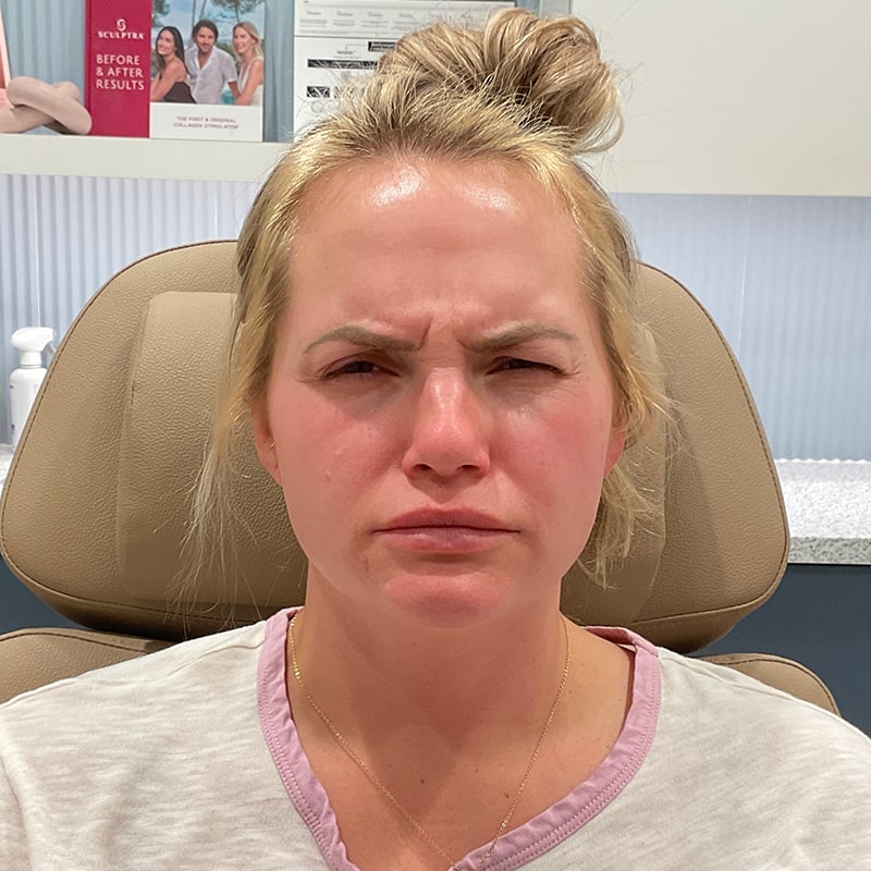 Botox & Dysport Before & After Image