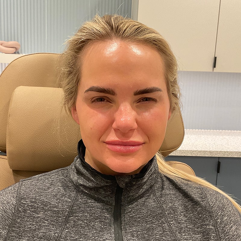 Botox & Dysport Before & After Image