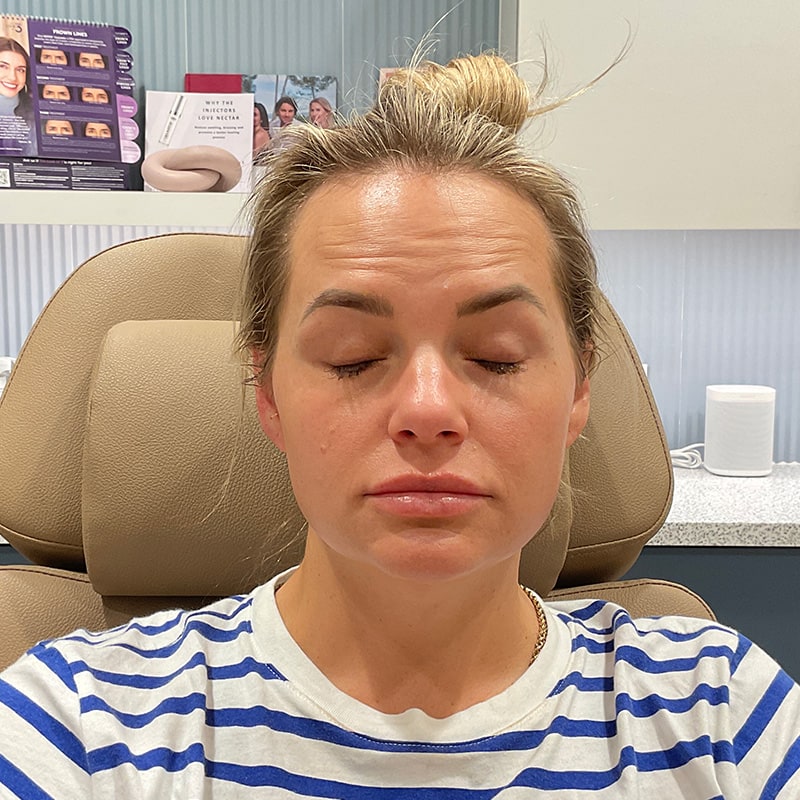 Botox & Dysport Before & After Image