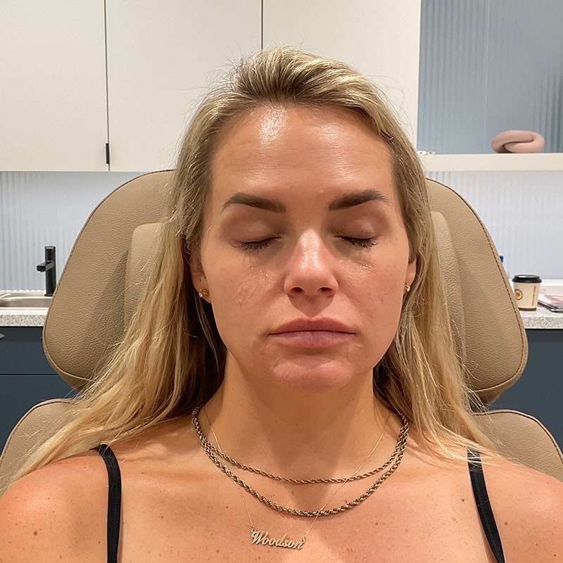 Botox & Dysport Before & After Image