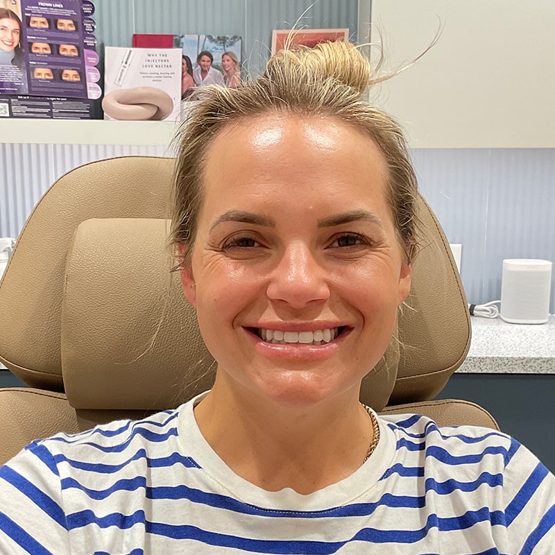 Botox & Dysport Before & After Image