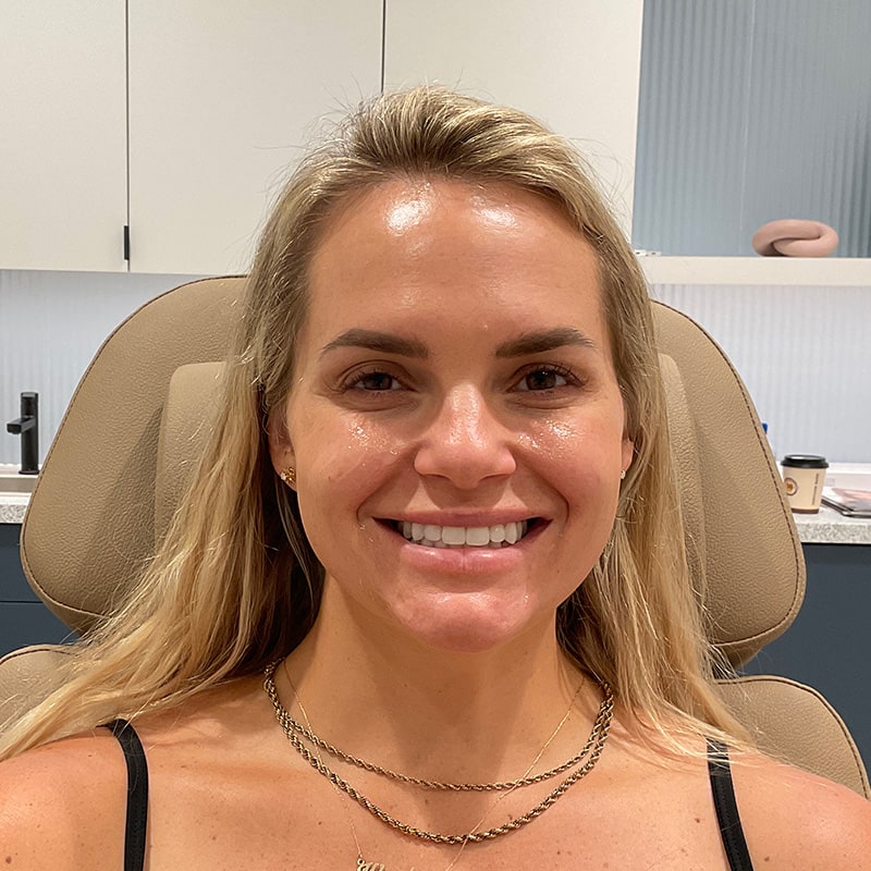 Botox & Dysport Before & After Image