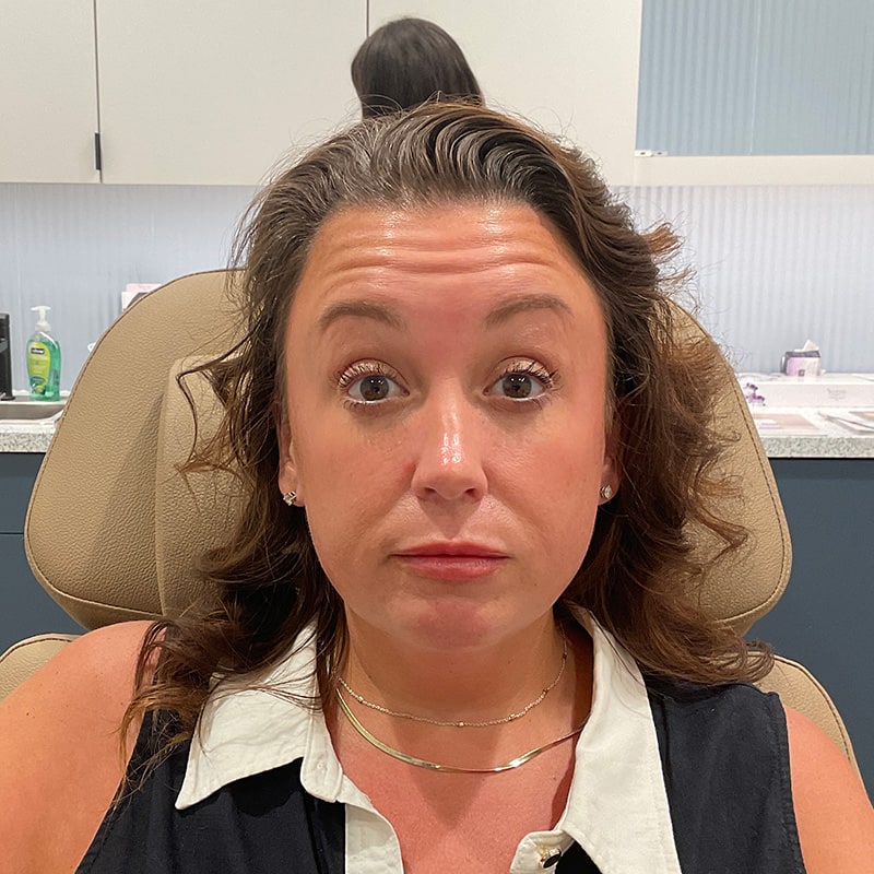 Botox & Dysport Before & After Image