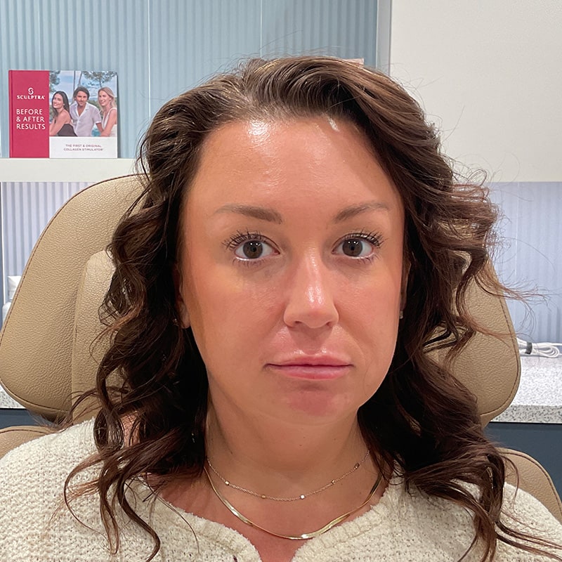 Botox & Dysport Before & After Image