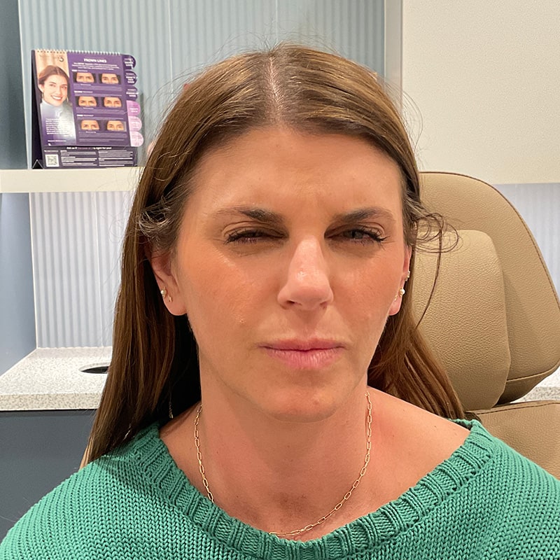 Botox & Dysport Before & After Image