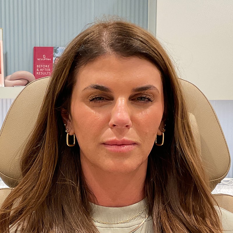 Botox & Dysport Before & After Image