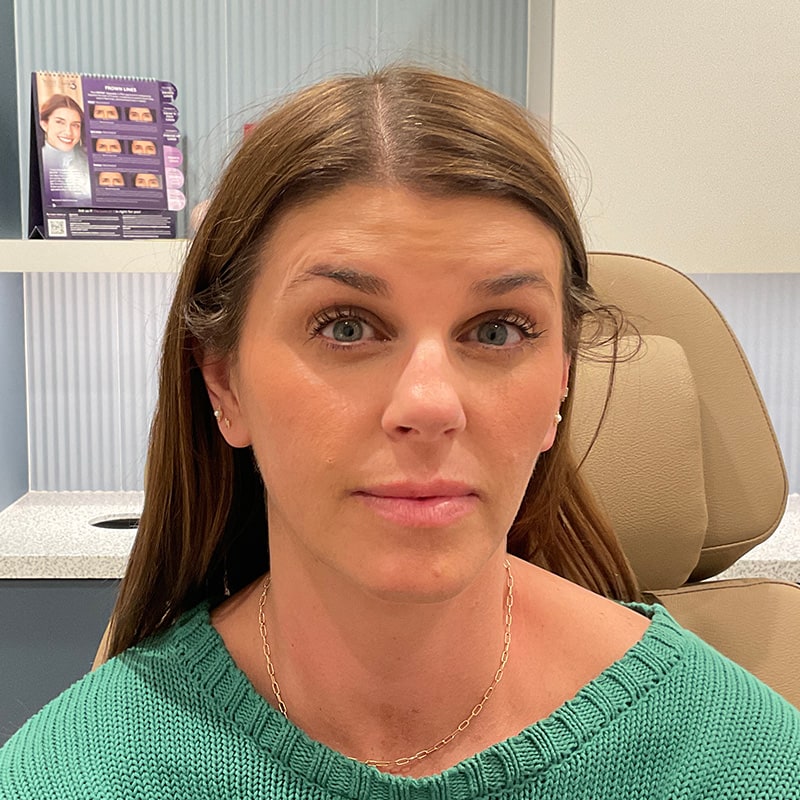 Botox & Dysport Before & After Image