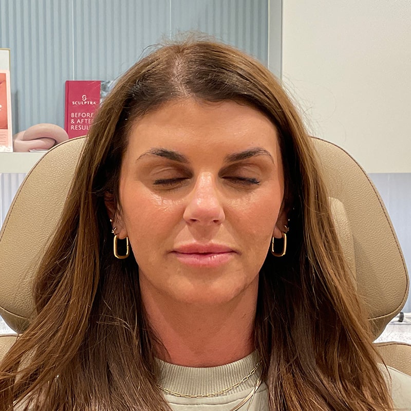 Botox & Dysport Before & After Image