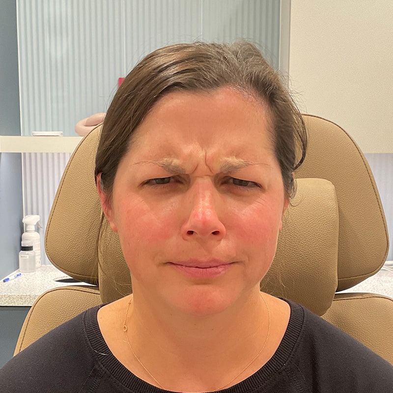 Botox & Dysport Before & After Image