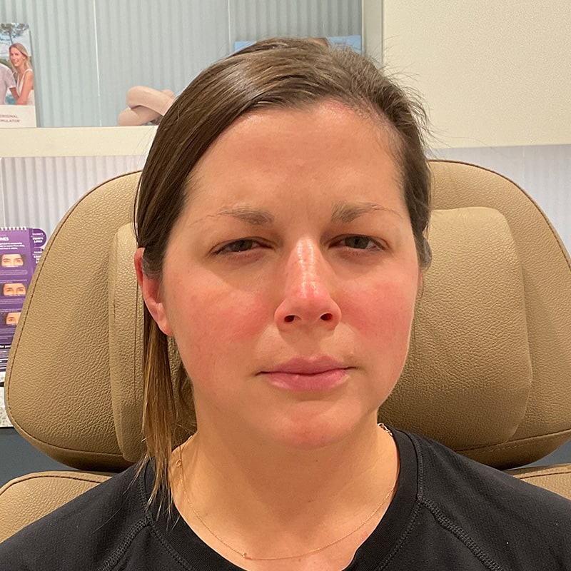 Botox & Dysport Before & After Image