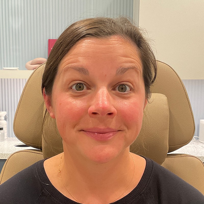 Botox & Dysport Before & After Image