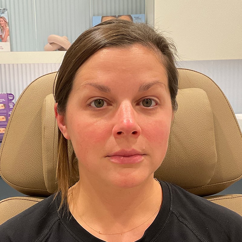 Botox & Dysport Before & After Image