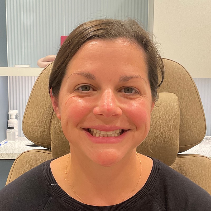 Botox & Dysport Before & After Image