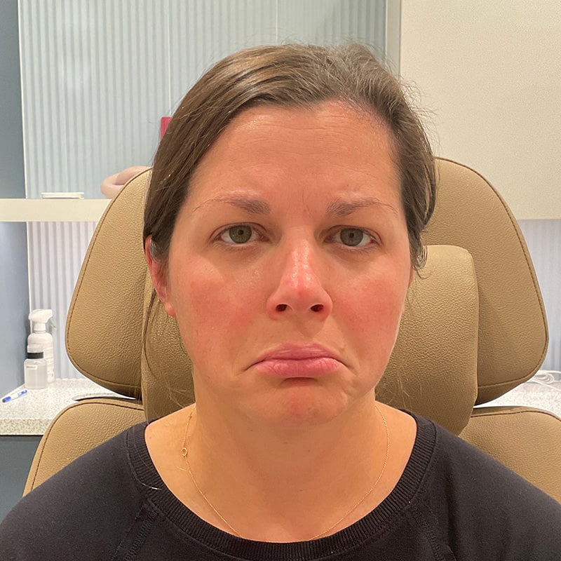 Botox & Dysport Before & After Image