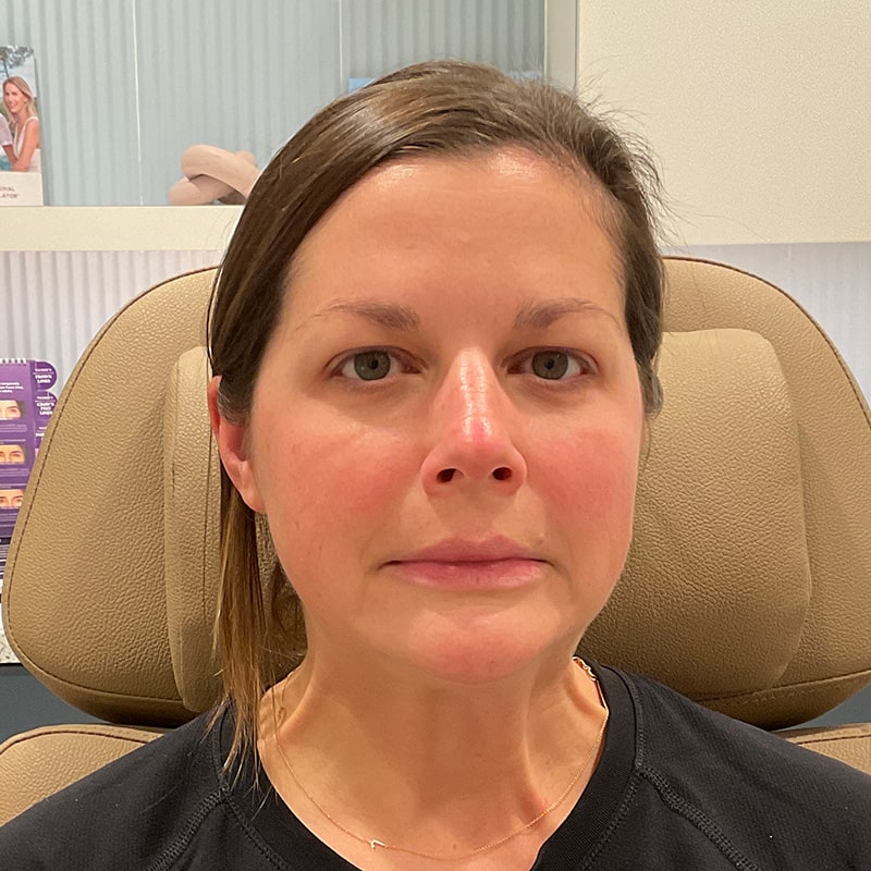 Botox & Dysport Before & After Image