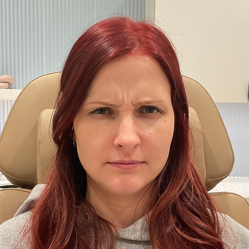 Botox & Dysport Before & After Image