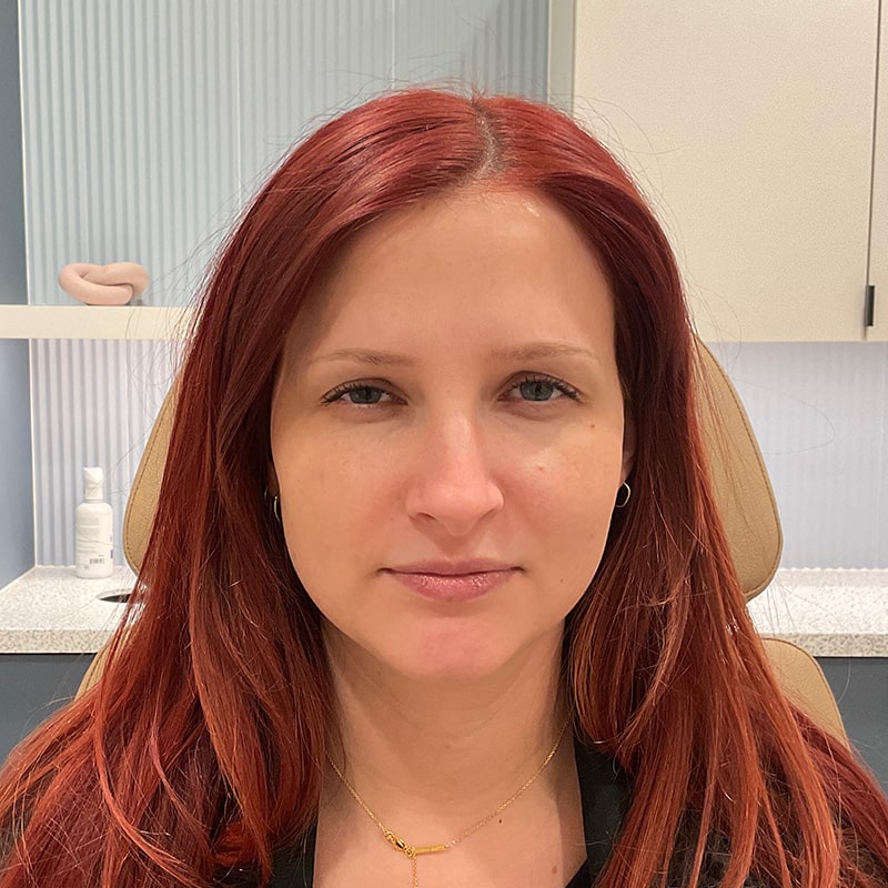 Botox & Dysport Before & After Image