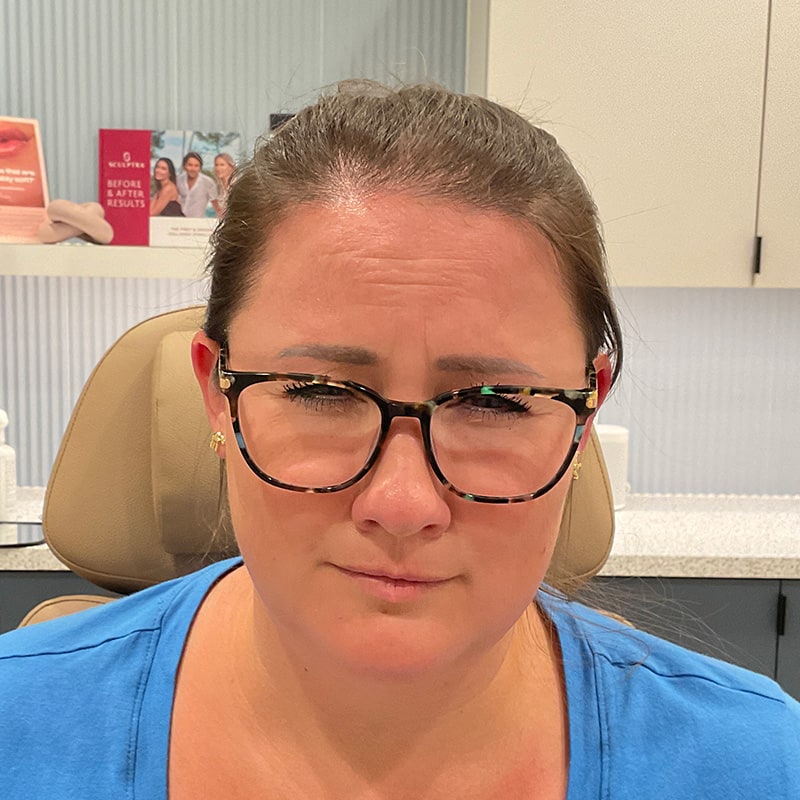 Botox & Dysport Before & After Image