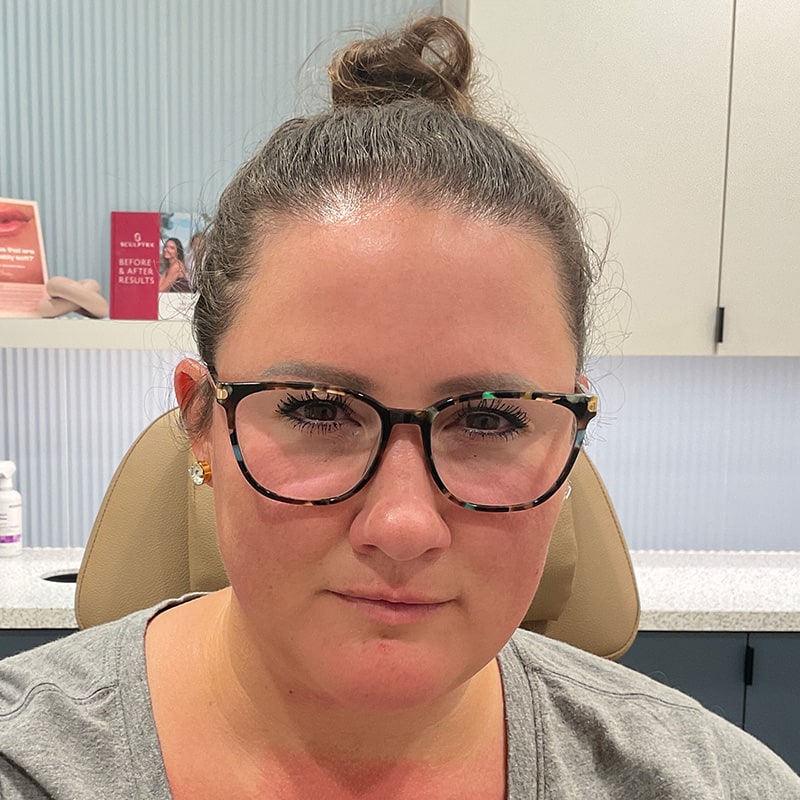 Botox & Dysport Before & After Image