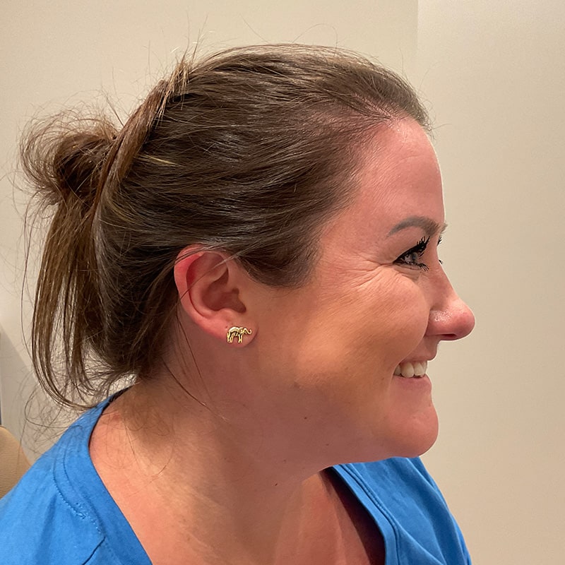 Botox & Dysport Before & After Image