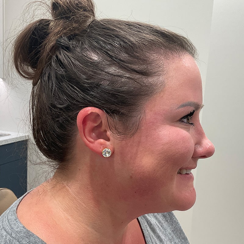 Botox & Dysport Before & After Image