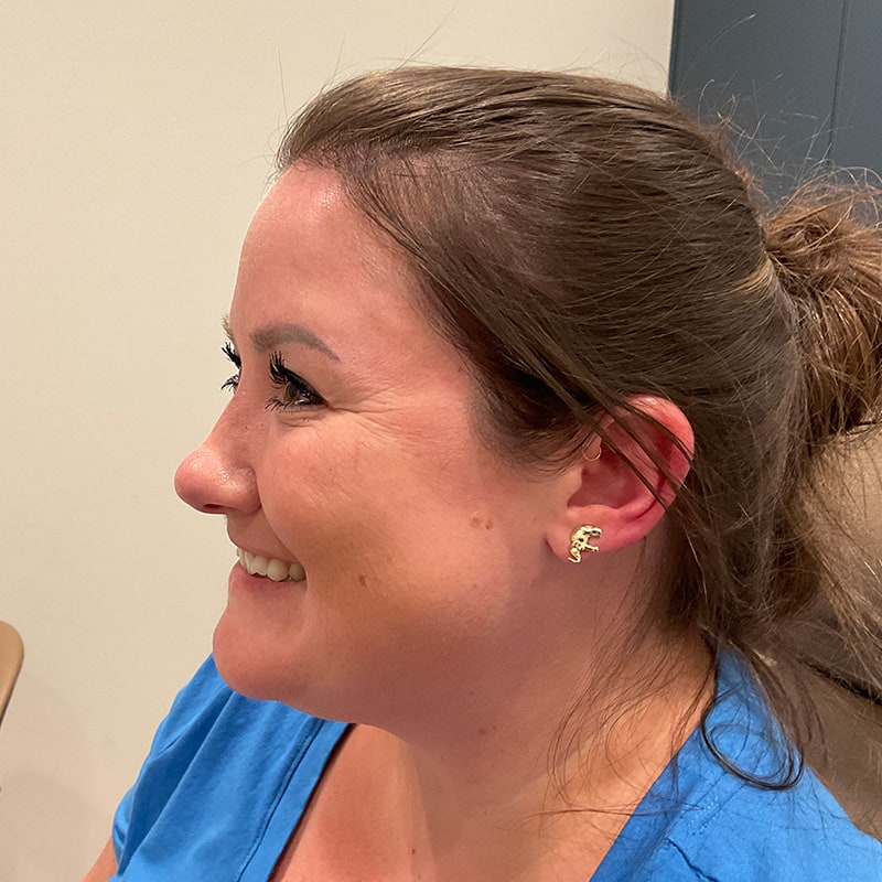 Botox & Dysport Before & After Image