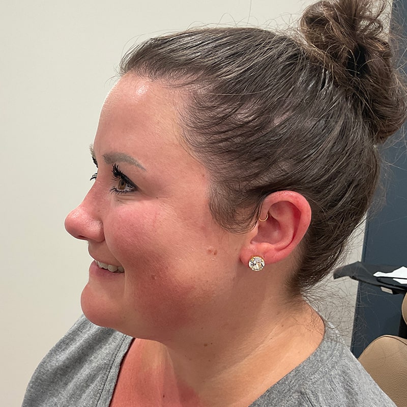 Botox & Dysport Before & After Image