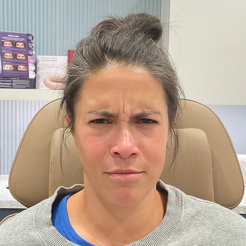 Botox & Dysport Before & After Image