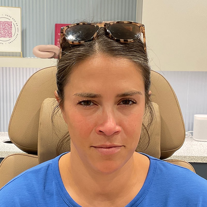 Botox & Dysport Before & After Image