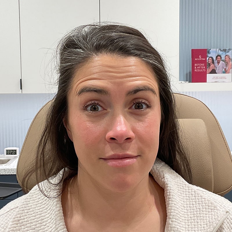 Botox & Dysport Before & After Image