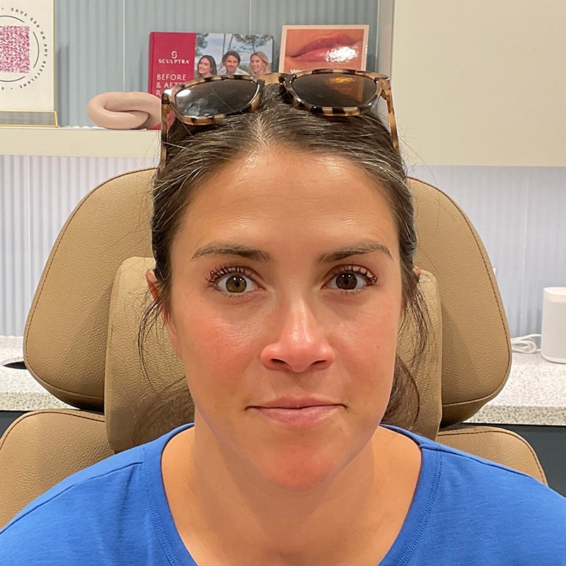 Botox & Dysport Before & After Image