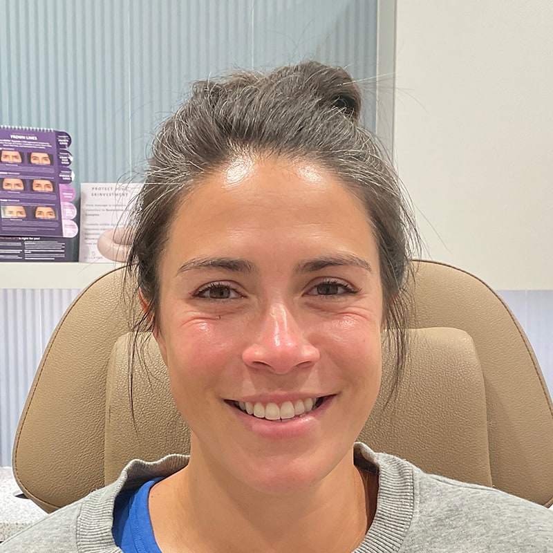 Botox & Dysport Before & After Image