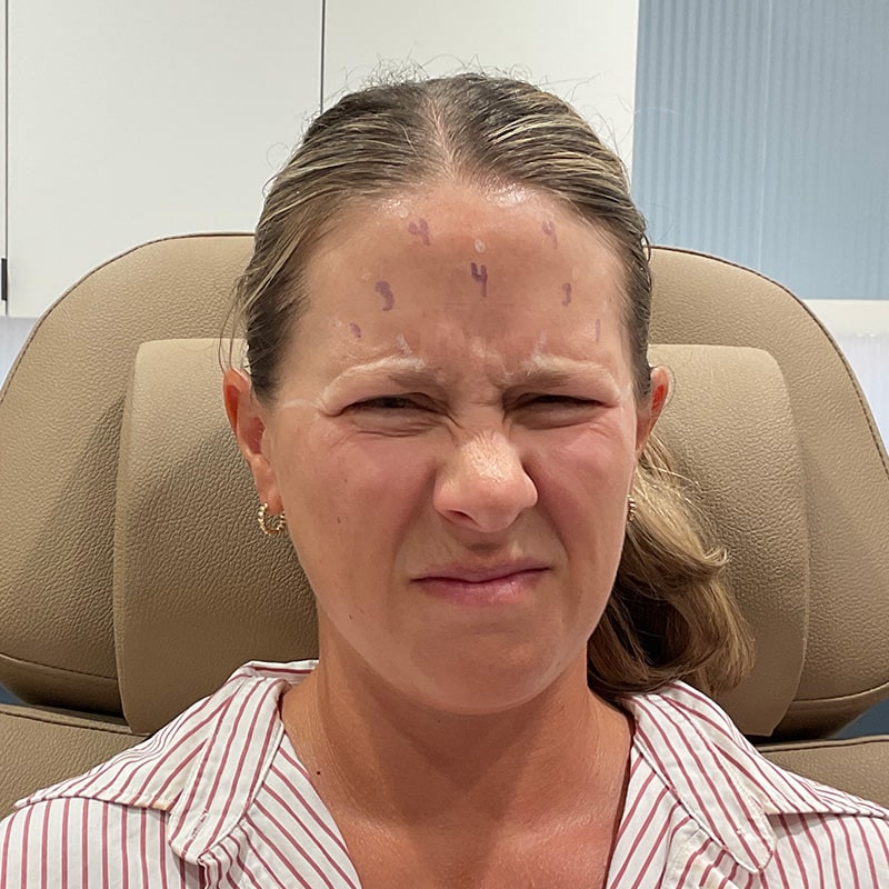 Botox & Dysport Before & After Image