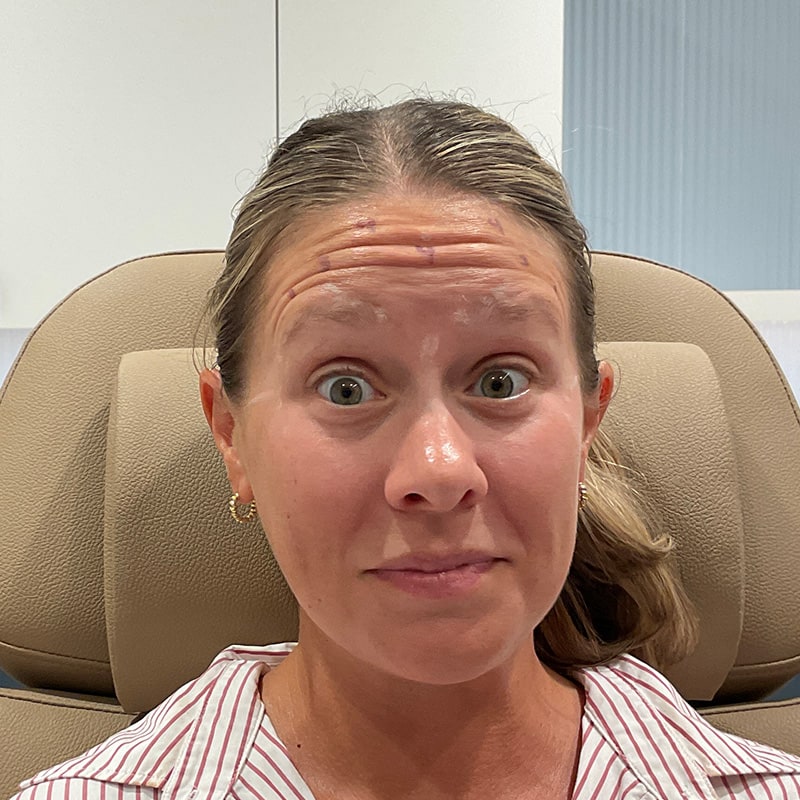 Botox & Dysport Before & After Image