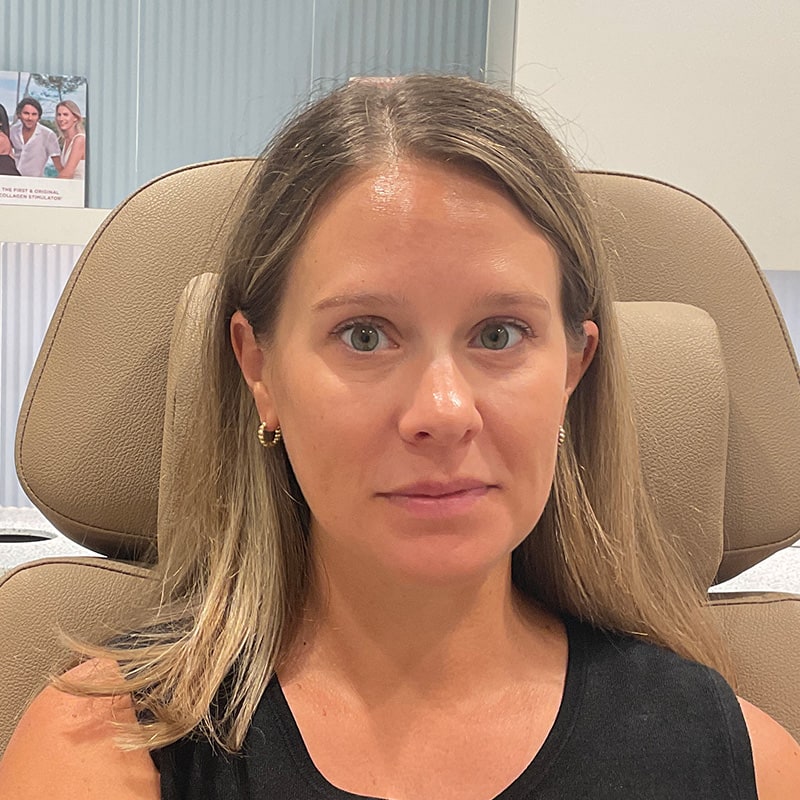 Botox & Dysport Before & After Image