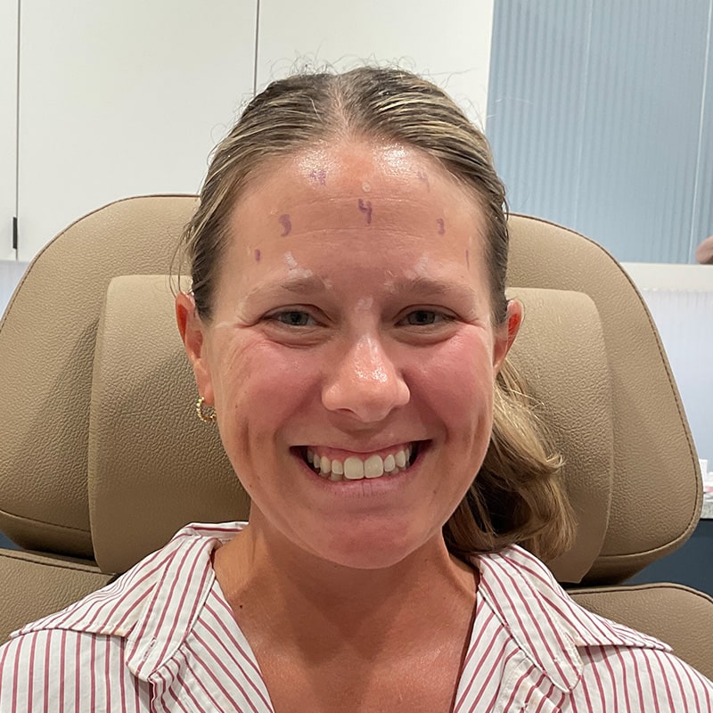 Botox & Dysport Before & After Image