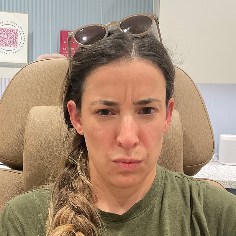 Botox & Dysport Before & After Image