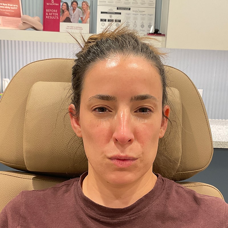 Botox & Dysport Before & After Image