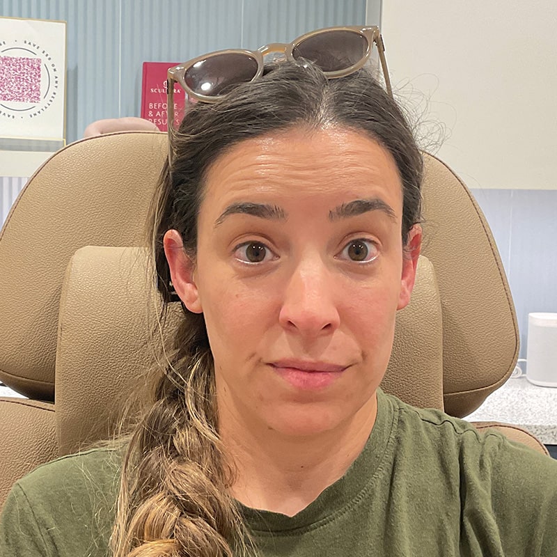 Botox & Dysport Before & After Image