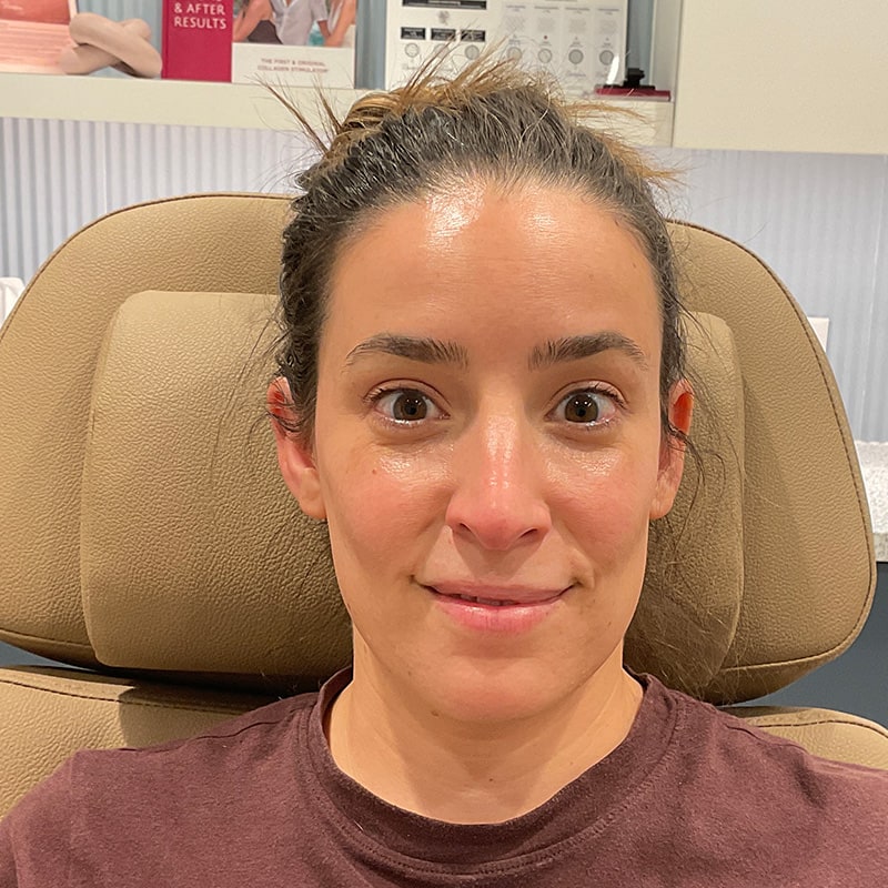 Botox & Dysport Before & After Image