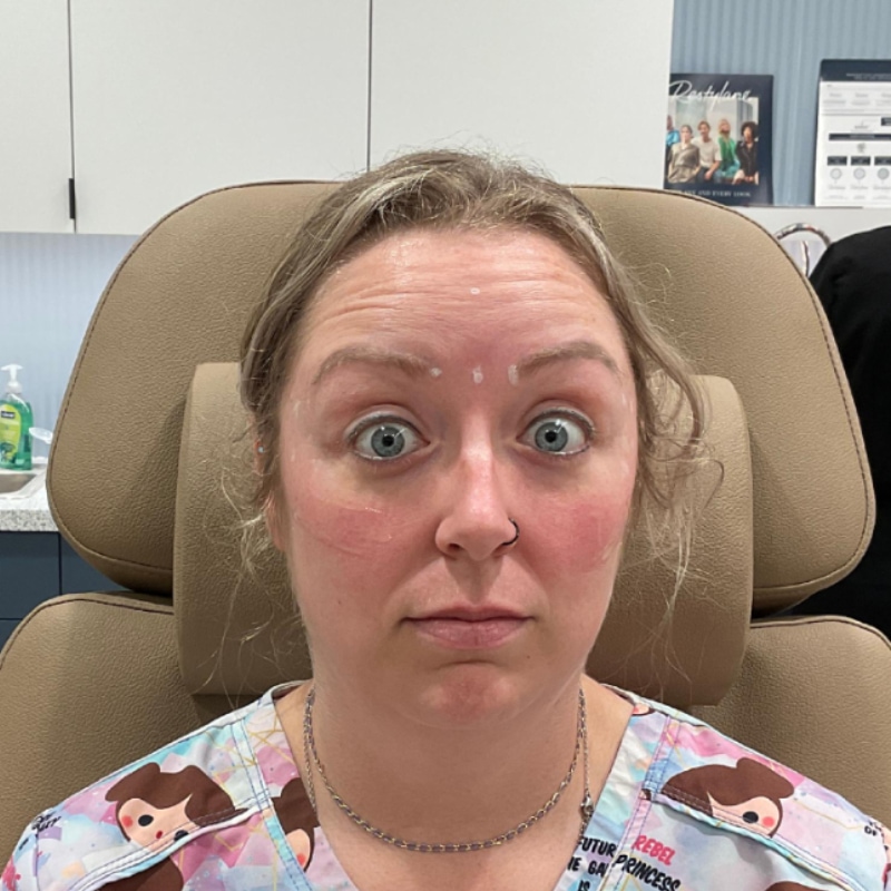 Botox & Dysport Before & After Image