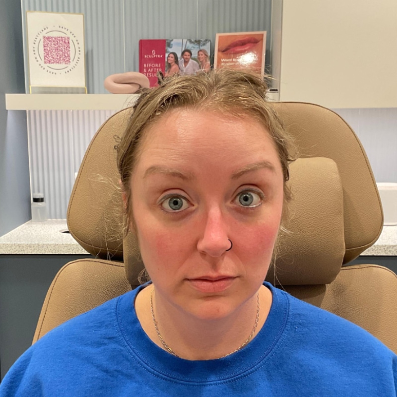 Botox & Dysport Before & After Image