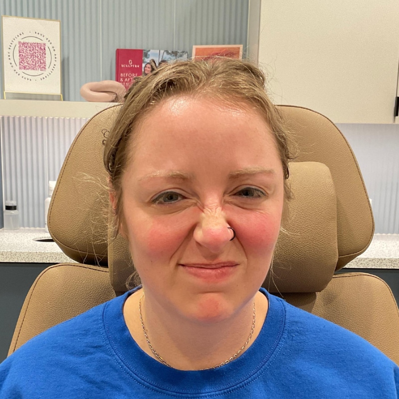 Botox & Dysport Before & After Image