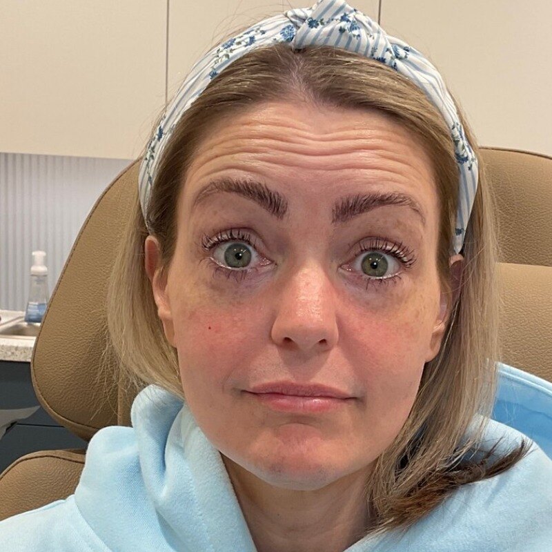 Botox & Dysport Before & After Image