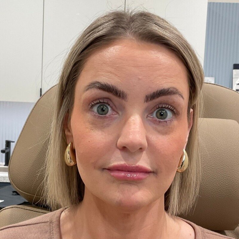 Botox & Dysport Before & After Image