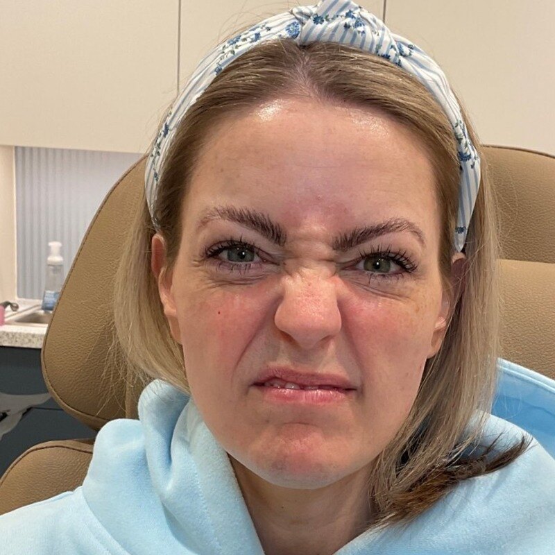 Botox & Dysport Before & After Image